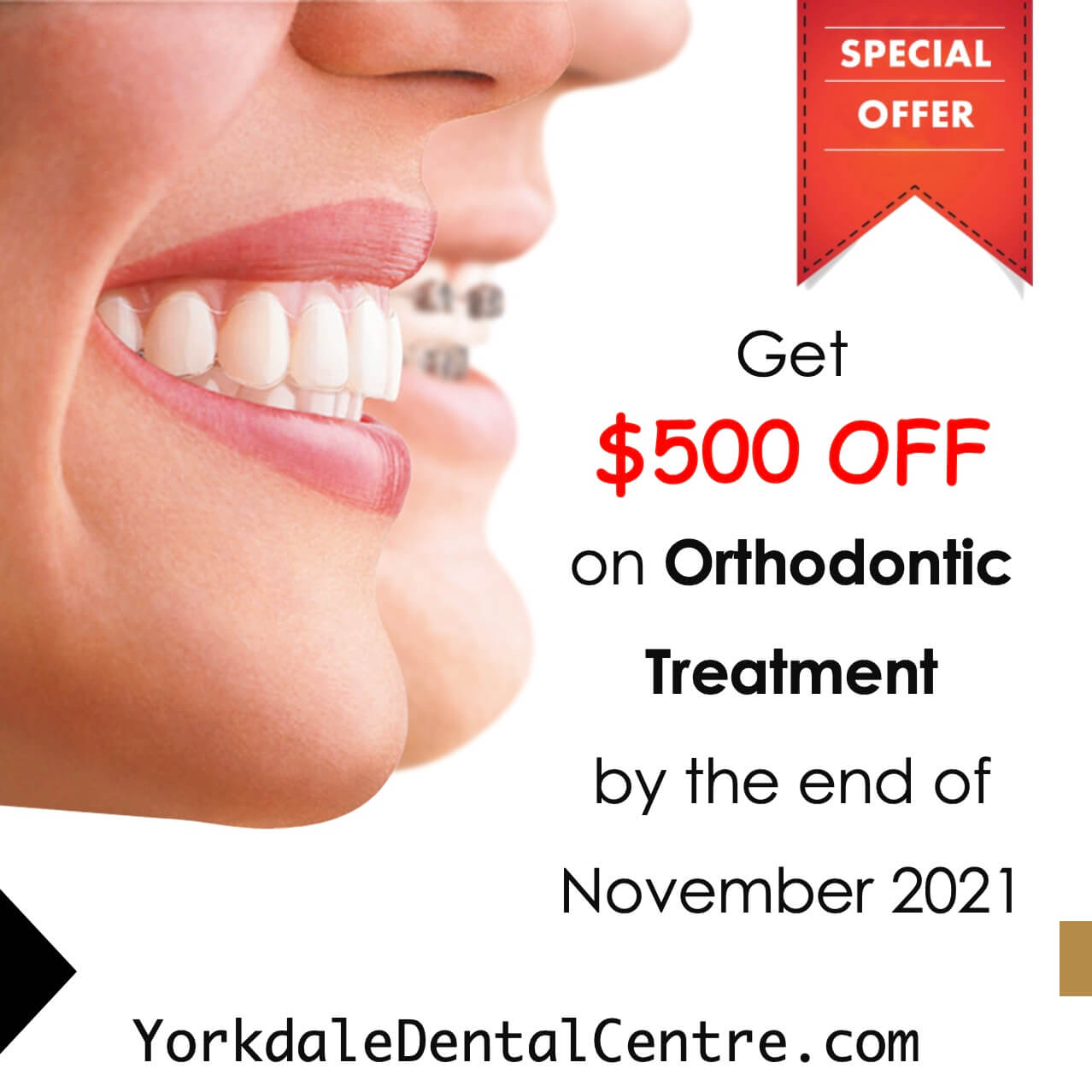 discount on Orthodontics treatment
